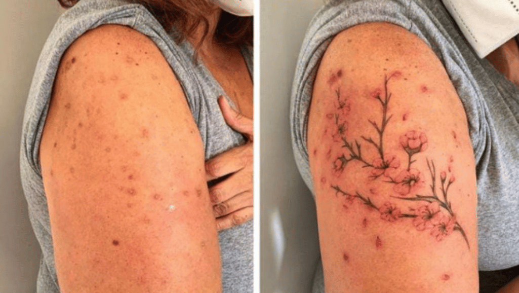Tattooing Over Scars: Your Questions Answered 1 Can you get a tattoo over scars