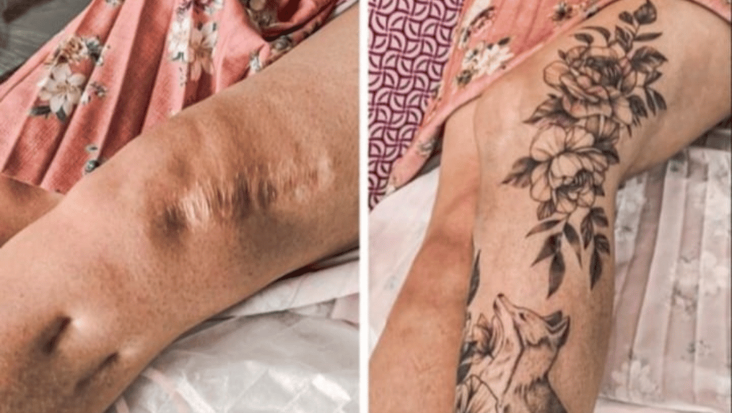 tattoo design for scar cover up Tattooing over scars