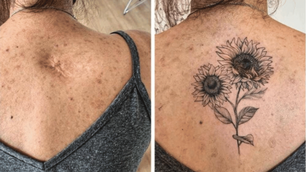 Can you get a tattoo over scars