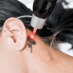 how many sessions to remove a tattoo