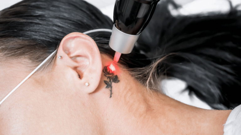 Tattoo Safety: On Antibiotics and Ink Decisions 5 how many sessions to remove a tattoo