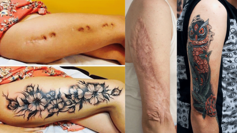 Tattooing Over Scars: Can It Be Done Best? 52 can i tattoo over a scar best one