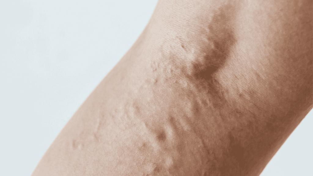 improved Over Spider Veins
